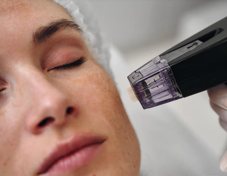 Microneedling