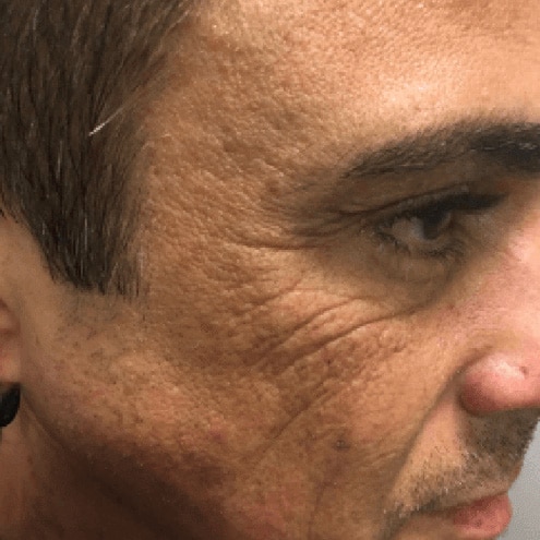 fine lines and wrinkles treatment