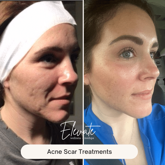 Before and After Acne Scar Treatments