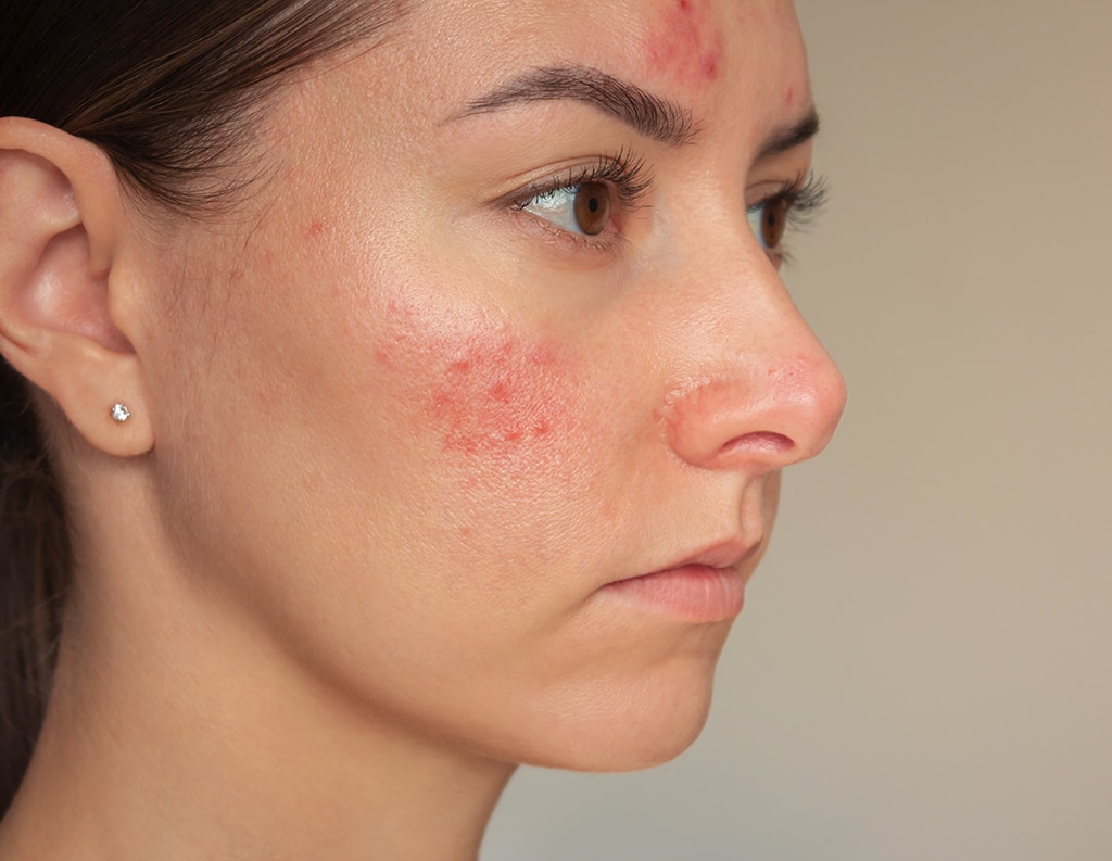 Woman With Rosacea